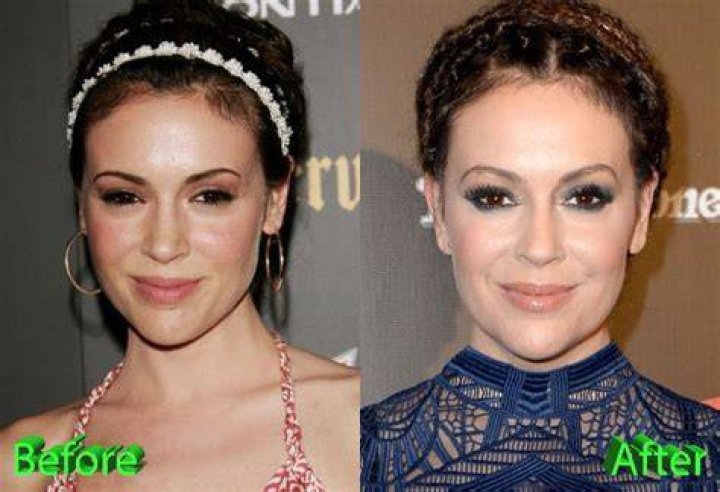 Alyssa Milano Plastic Surgery