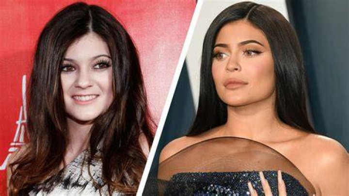 Kylie Jenner Before and after Surgery
