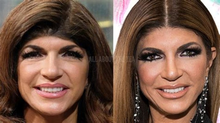 Teresa Giudice Forehead Surgery