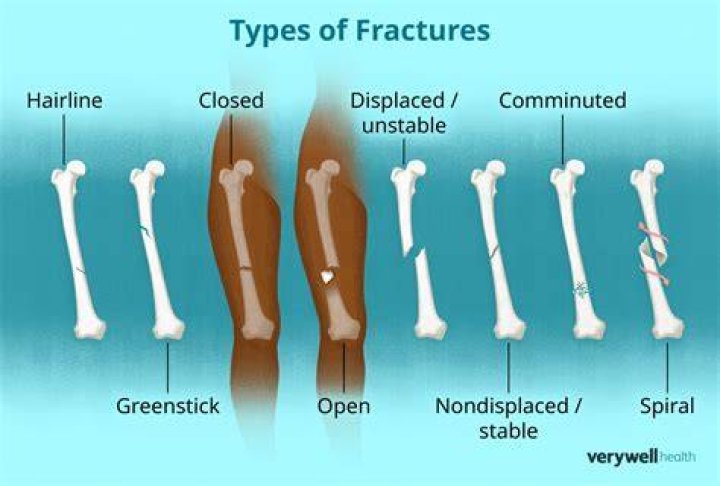 What happens if AU joint breaks?